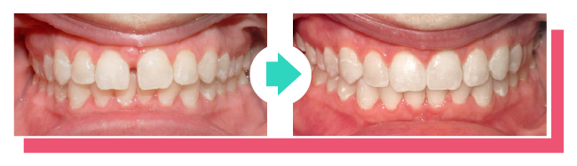 Clear Correct vs. Invisalign